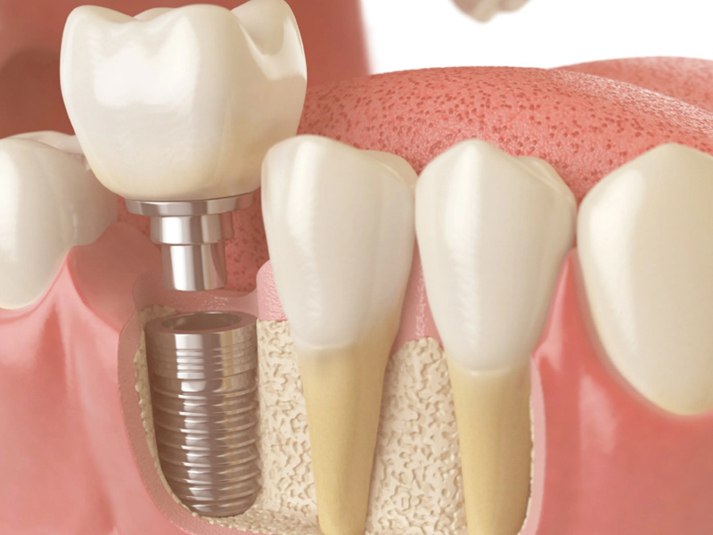 Diş Kemik Grefti: Ameliyat Süreci, Tedavi Yöntemleri ve Merak Edilenler